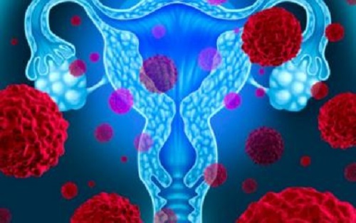 4 giai đoạn ung thư cổ tử cung do nhiễm HPV