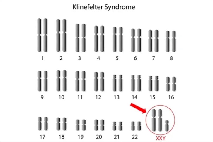bộ nhiễm sắc thể hội chứng Klinefelter