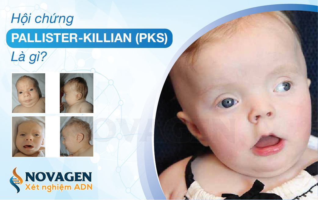 Hội Chứng Pallister-Killian (PKS) - Bất thường nhiễm sắc thể số 12