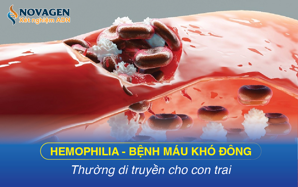Hemophilia - Bệnh Máu Khó Đông Thường Di Truyền Cho Con Trai 