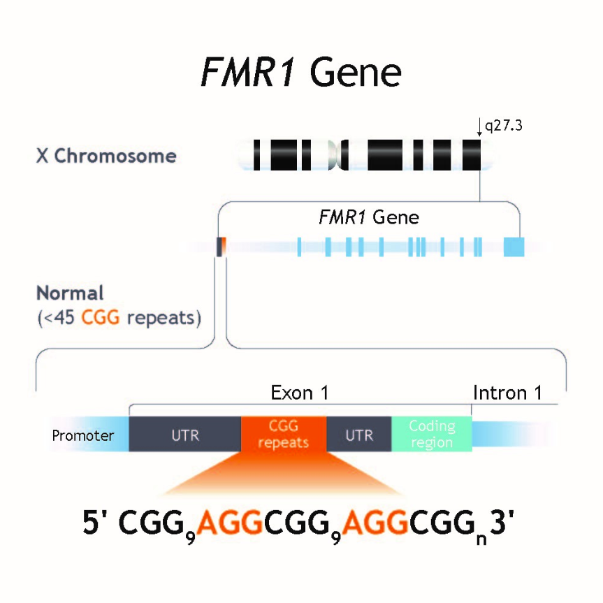 Gen FMR1 gây hội chứng Fragile X