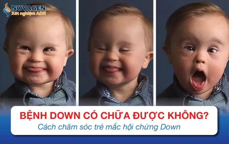 Bệnh Down Có Chữa Được Không? Cách Chăm Sóc Trẻ Mắc Hội Chứng Down