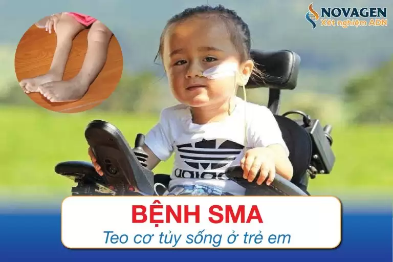Bệnh SMA – Teo Cơ Tủy Sống Ở Trẻ Em
