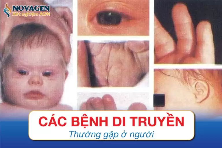 Các Bệnh Di Truyền Thường Gặp Ở Người