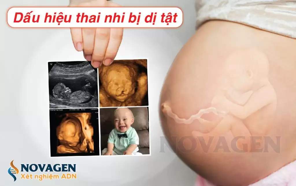Dấu Hiệu Thai Nhi Bị Dị Tật Và Cách Phát Hiện Sớm, Mẹ Bầu Lưu Ý