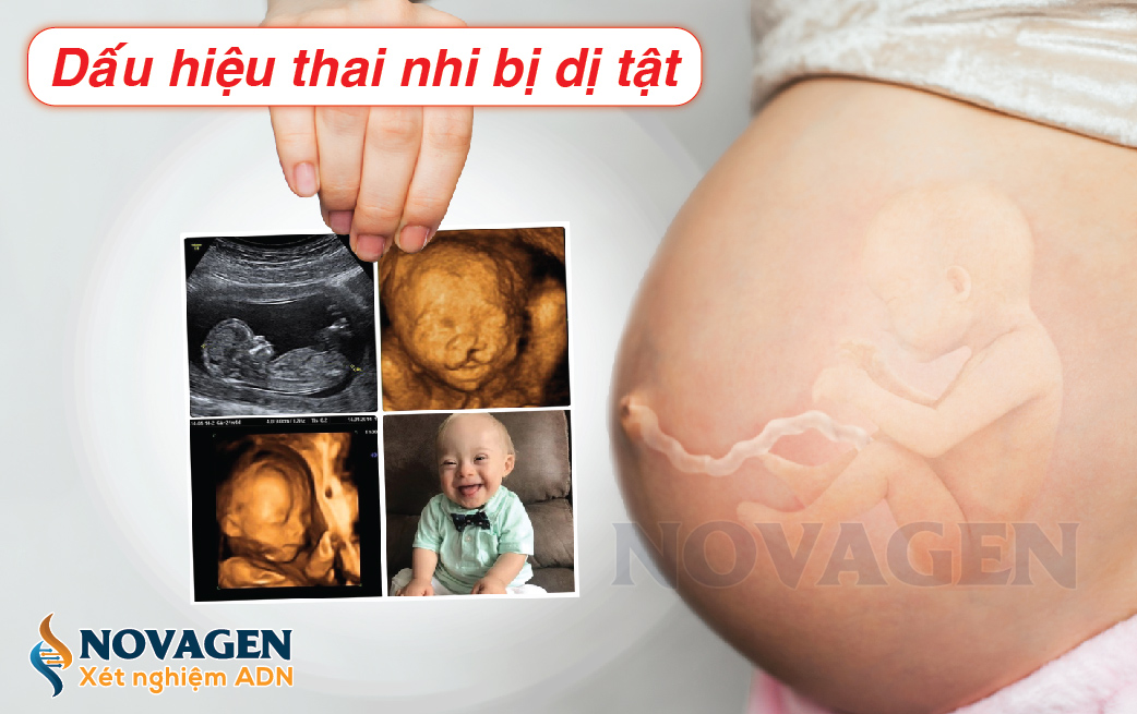 Dấu Hiệu Thai Nhi Bị Dị Tật: Những Điều Mẹ Bầu Cần Biết