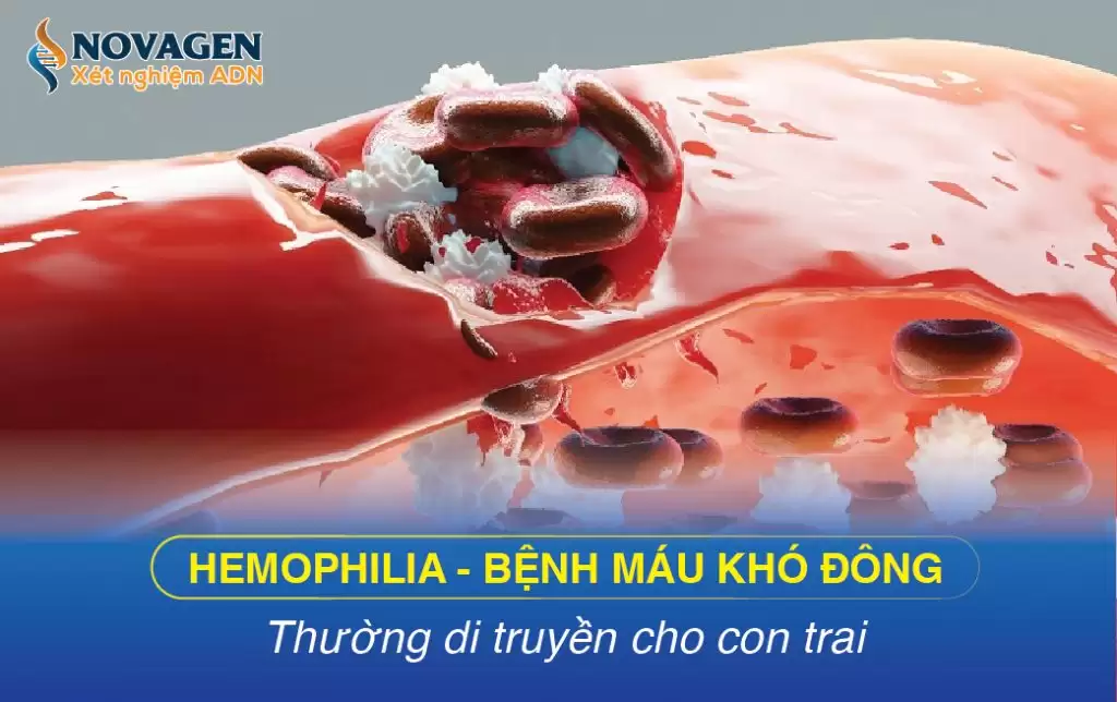 Hemophilia – Bệnh Máu Khó Đông Thường Di Truyền Cho Con Trai
