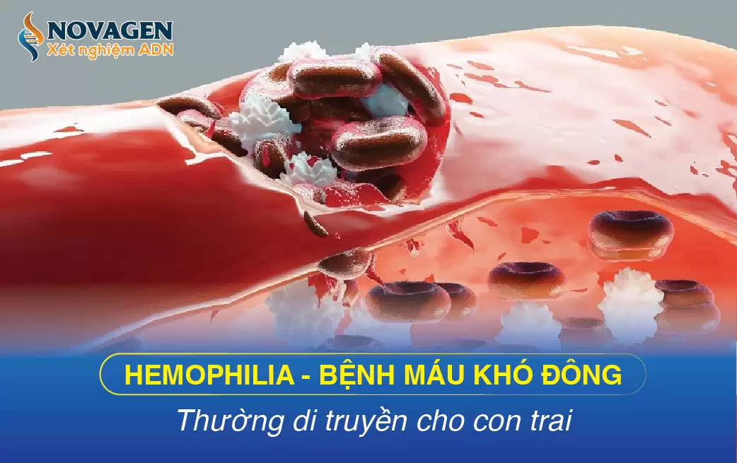 Hemophilia - Bệnh Máu Khó Đông Thường Di Truyền Cho Con Trai