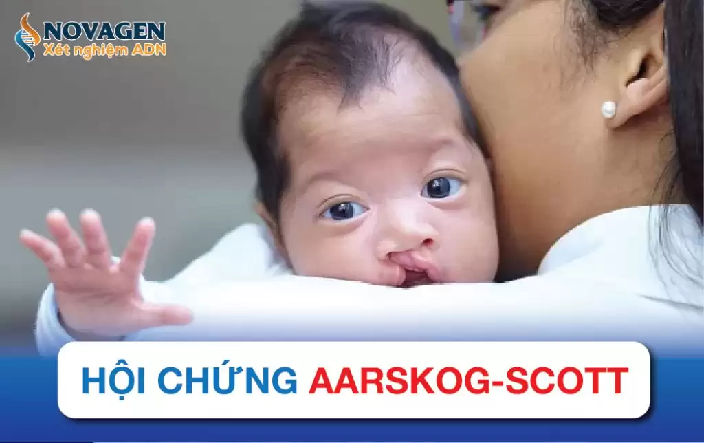 Hội Chứng Aarskog-Scott – Đột Biến Nhiễm Sắc Thể X