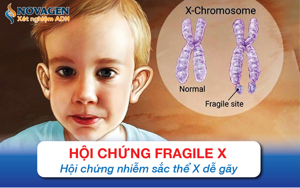 Hội chứng Fragile X - Hội chứng nhiễm sắc thể X dễ gãy