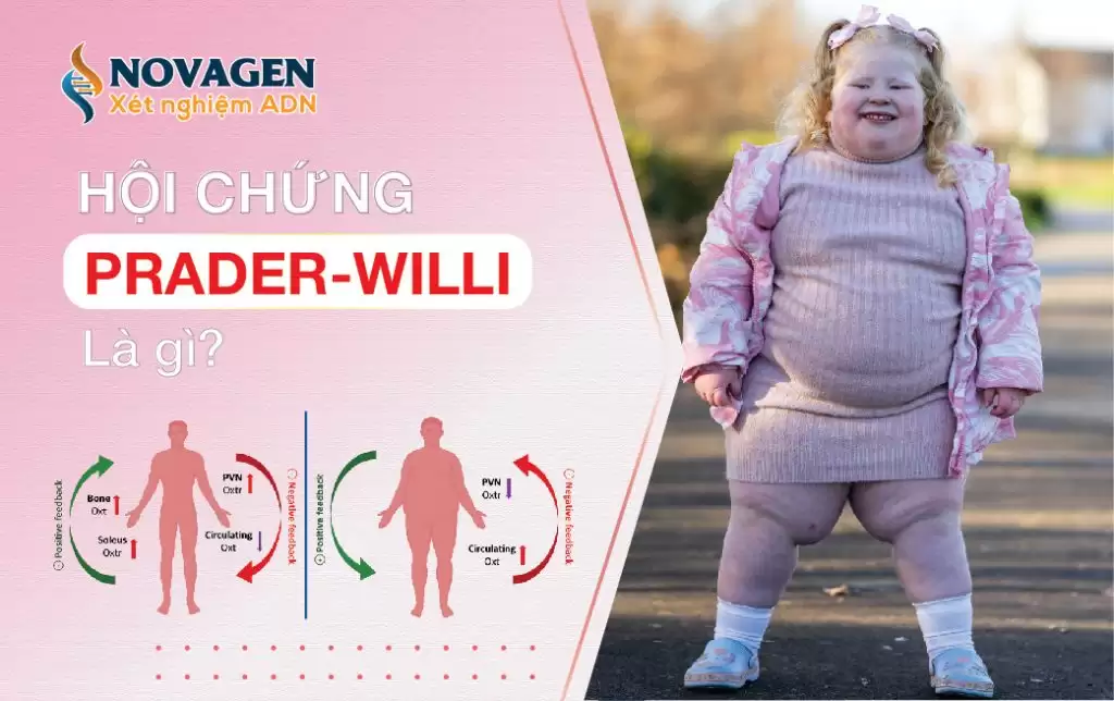 Hội Chứng Prader-Willi