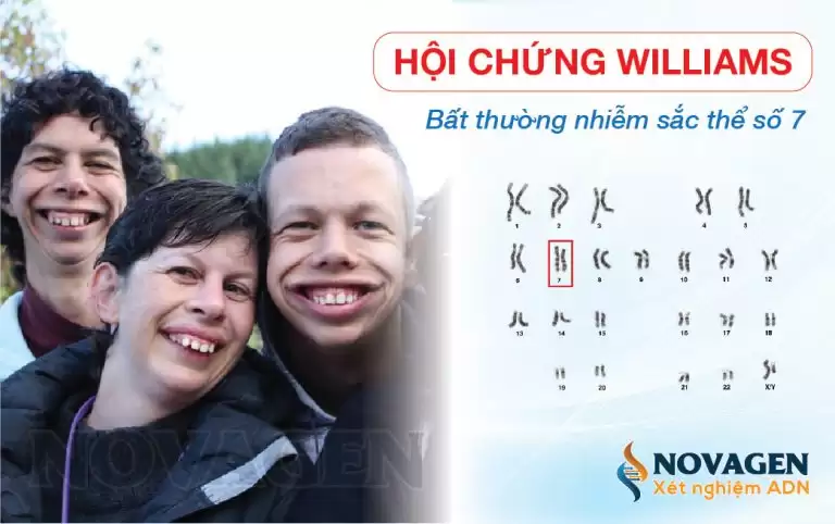 Hội Chứng Williams – Bất Thường Nhiễm Sắc Thể Số 7