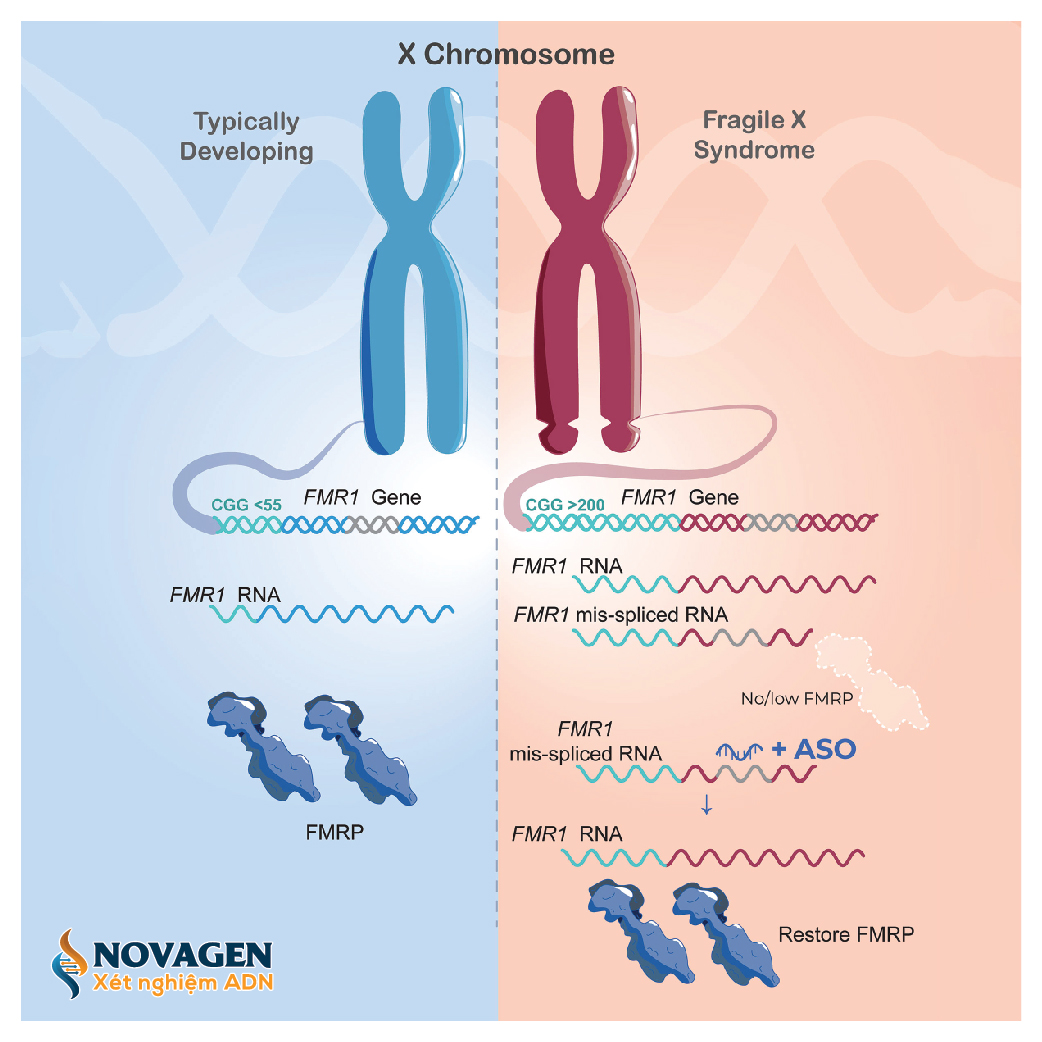Nguyên nhân gây ra hội chứng Fragile X