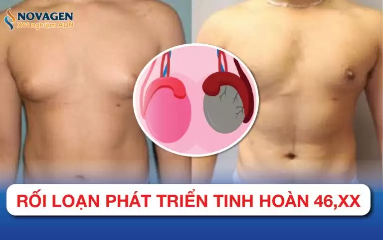 Rối Loạn Phát Triển Tinh Hoàn 46,XX