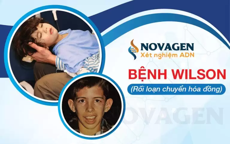 Bệnh Wilson (Rối Loạn Chuyển Hóa Đồng)