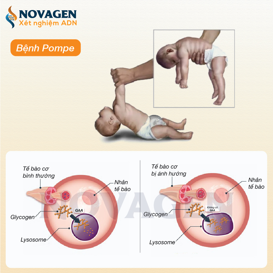 Rối Loạn Dự Trữ Glycogen Type 2: Nguyên Nhân, Triệu Chứng Và Cách Điều Trị Hiệu Quả