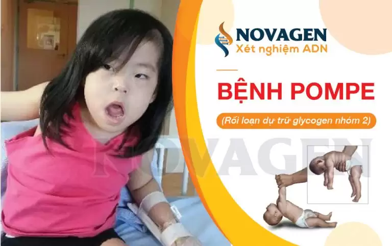 Bệnh Pompe – Rối Loạn Dự Trữ Glycogen Nhóm 2