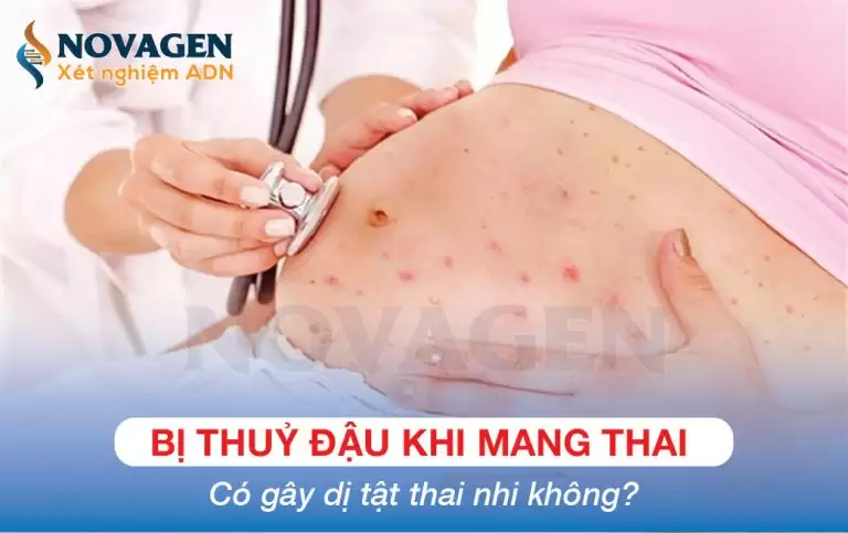 Bị Thuỷ Đậu Khi Mang Thai Có Gây Dị Tật Thai Nhi Không?