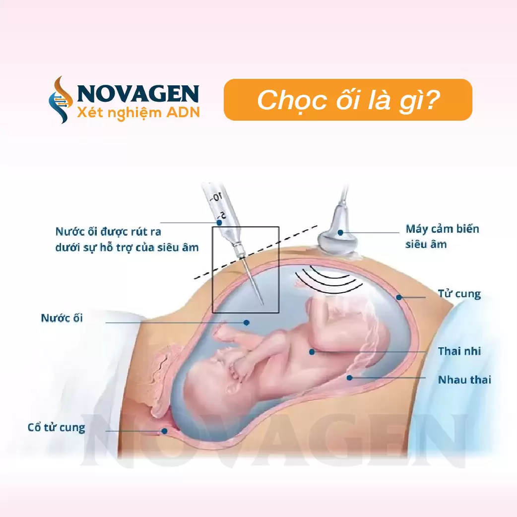 Chọc ối là gì? Xét nghiệm ADN thai nhi chọc ối