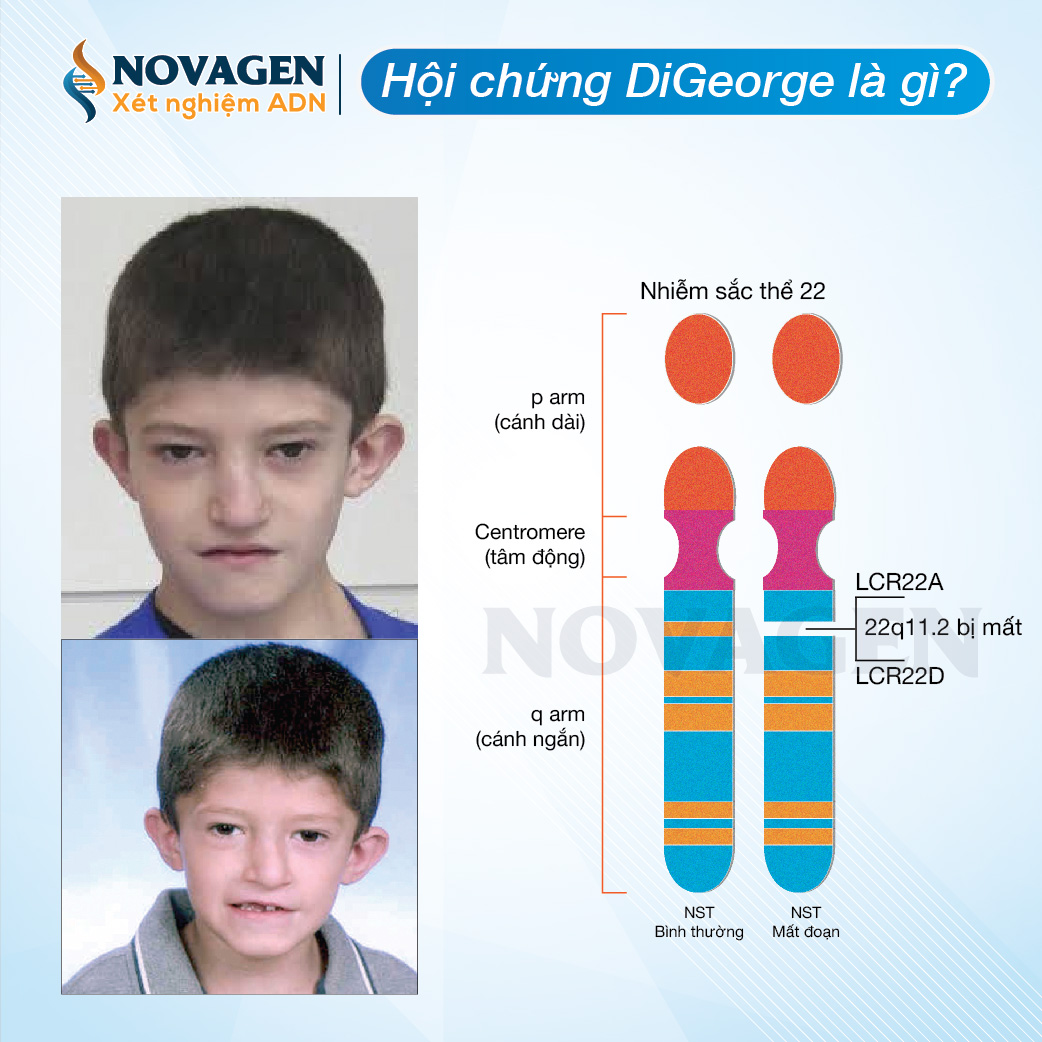 NST 22 là gì? Tìm hiểu về Hội chứng và Ảnh hưởng Đột biến Nhiễm sắc thể 22