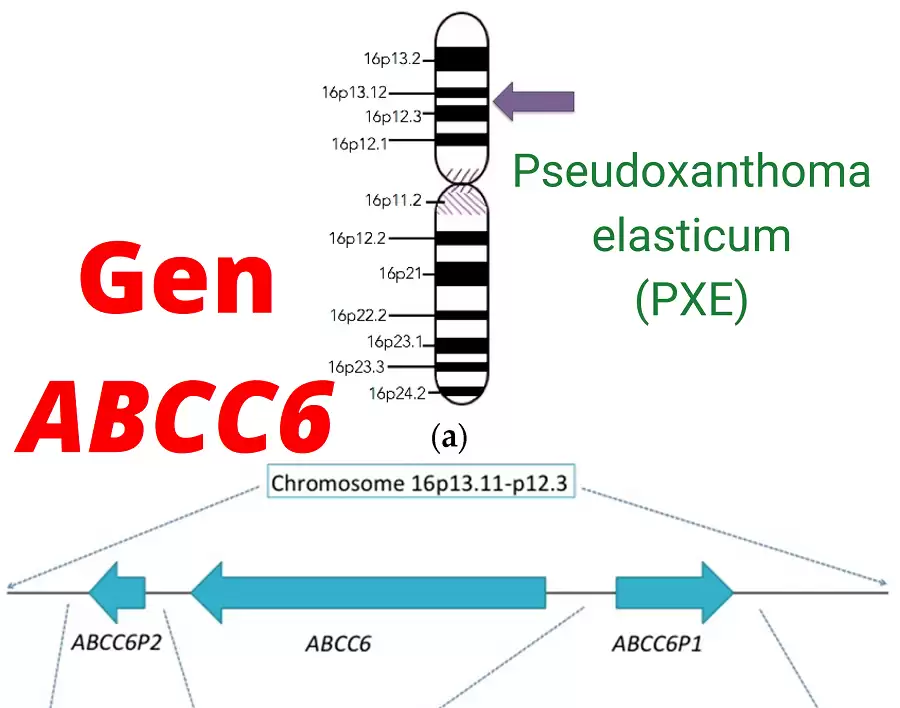 Gen ABCC6 Và Bệnh Di Truyền Lặn Trên Nhiễm Sắc Thể Thường