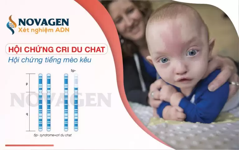 Hội Chứng Cri Du Chat – Hội Chứng Tiếng Mèo Kêu