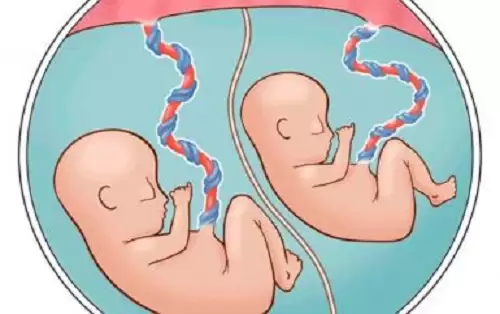 Hội Chứng Truyền Máu Song Thai – Twin-To-Twin Transfusion Syndrome
