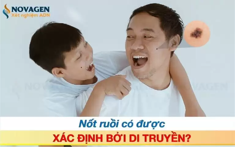 Nốt Ruồi Có Được Xác Định Bởi Di Truyền?