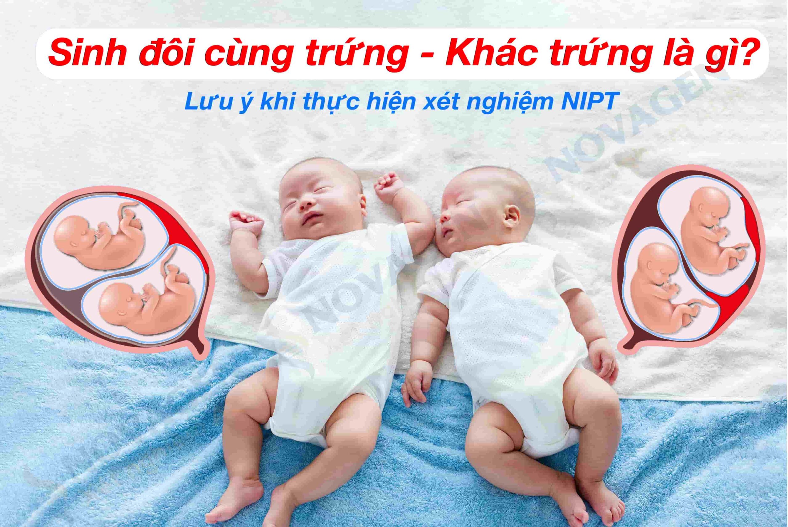 Sinh Đôi Cùng Trứng - Khác Trứng Là Gì? Lưu Ý Khi Thực Hiện Xét Nghiệm NIPT Khi Mang Thai Đôi