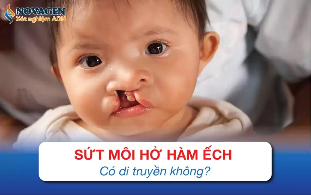 Sứt Môi Hở Hàm Ếch Có Di Truyền Không?
