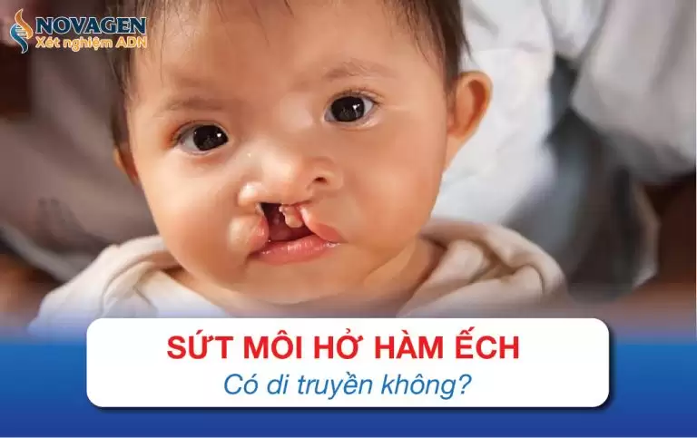 Sứt Môi Hở Hàm Ếch Có Di Truyền Không?
