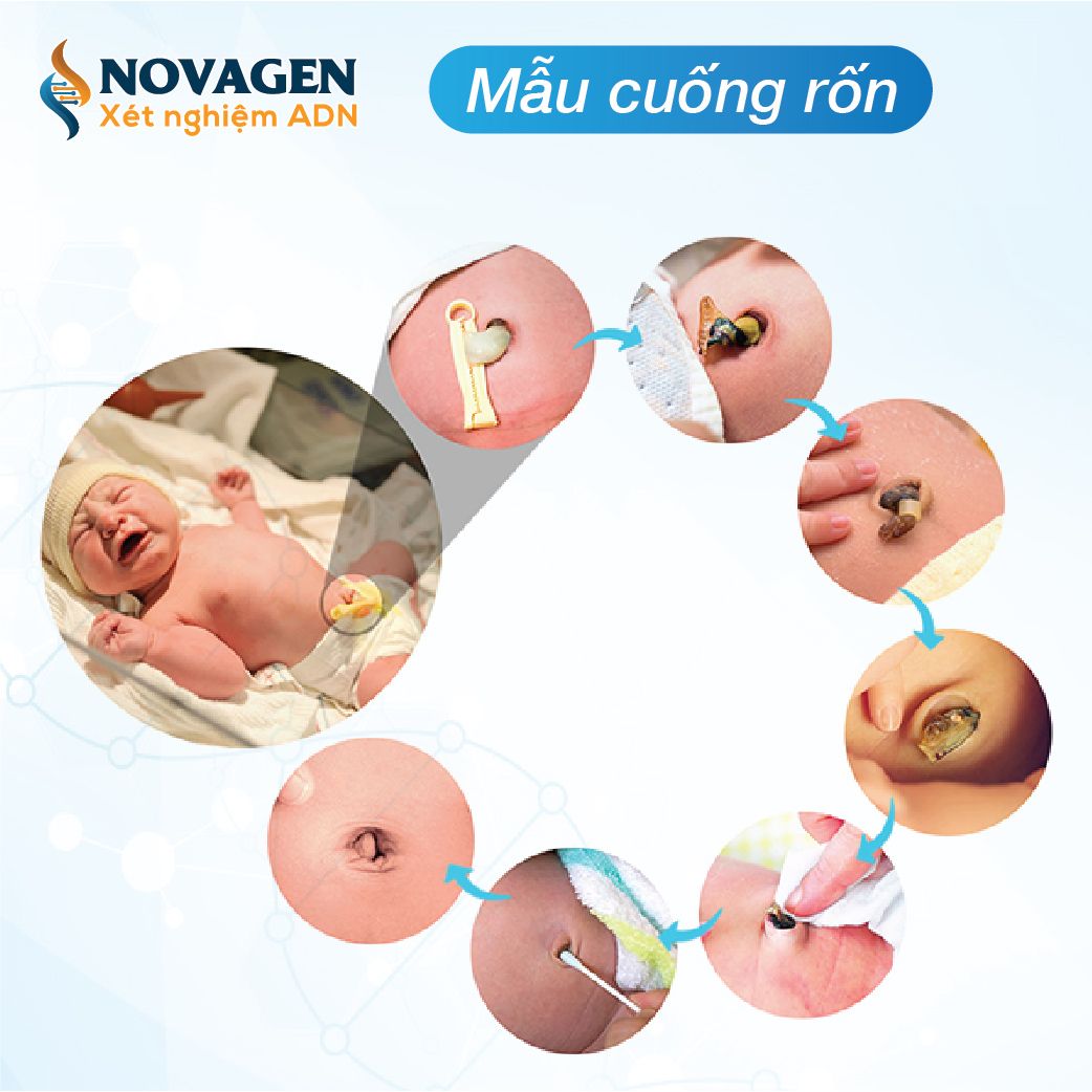 Thu mẫu cuống rốn để xét nghiệm ADN