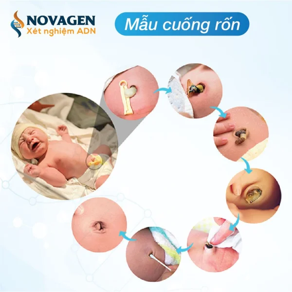 Ưu tiên sử dụng phần cuống rốn khô của trẻ sơ sinh để xét nghiệm ADN