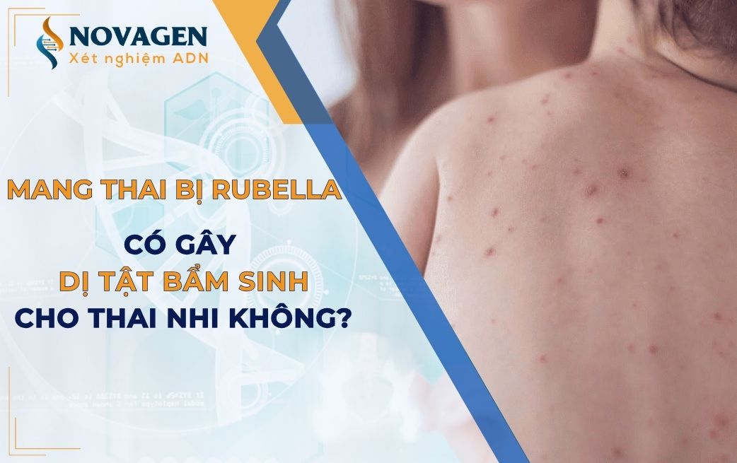 Mang thai bị Rubella có nguy cơ gây dị tật bẩm sinh cho thai nhi không