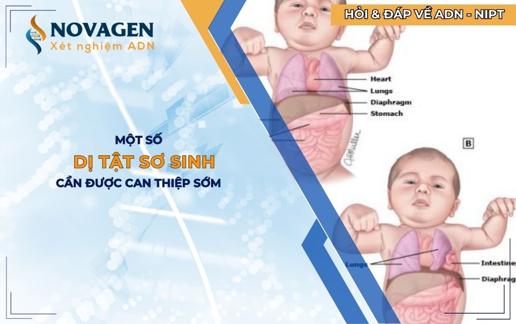 Một số dị tật sơ sinh cần được can thiệp sớm