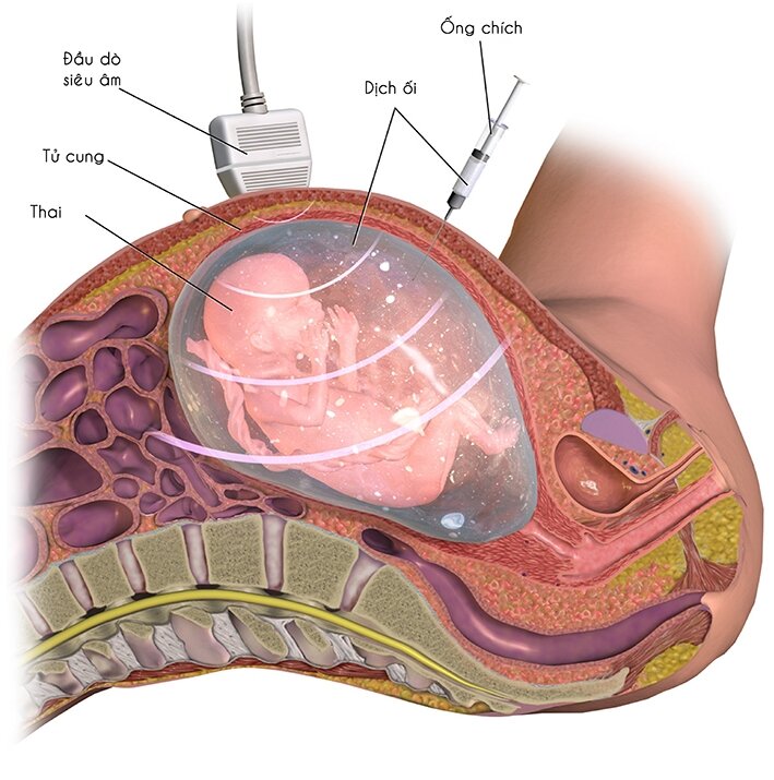 Tại sao thai to thì không chọc ối xét nghiệm ADN thai nhi được? 