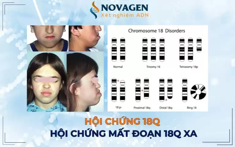 Hội chứng 18q – Hội chứng mất đoạn 18q xa