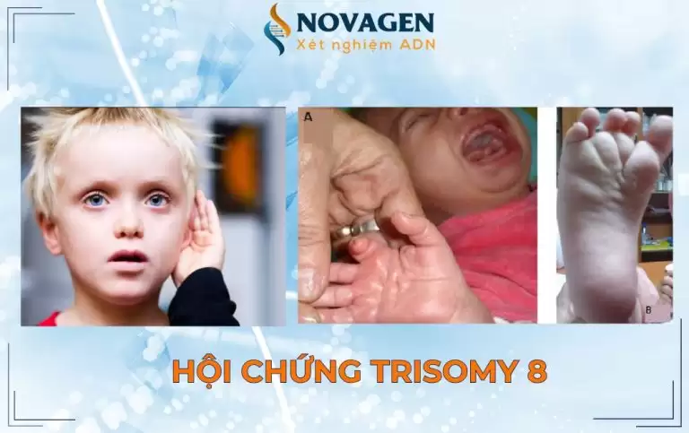 Hội chứng Trisomy 8 – Hội chứng thể khảm tam nhiễm sắc thể 8