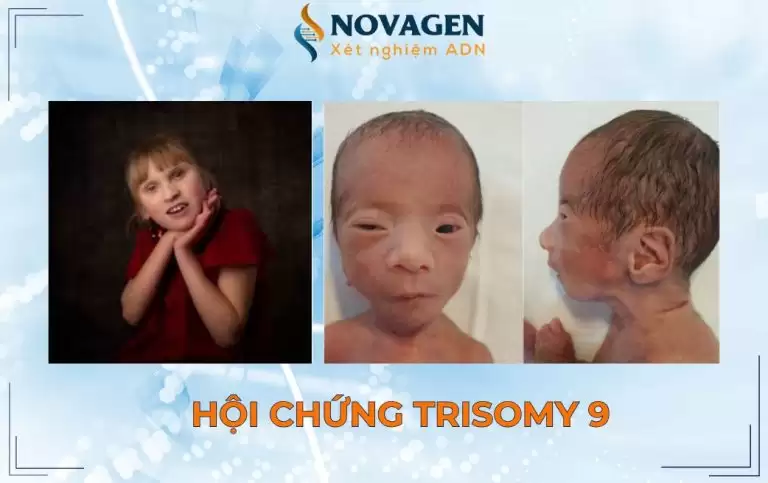 Hội chứng Trisomy 9 – Tam nhiễm sắc thể số 9