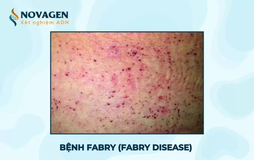 Bệnh Fabry: Rối loạn di truyền chuyển hóa và tích trữ mỡ 