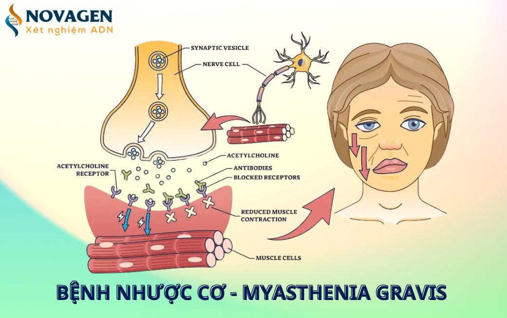 Bệnh nhược cơ là gì? Nguyên nhân, triệu chứng và phương pháp điều trị