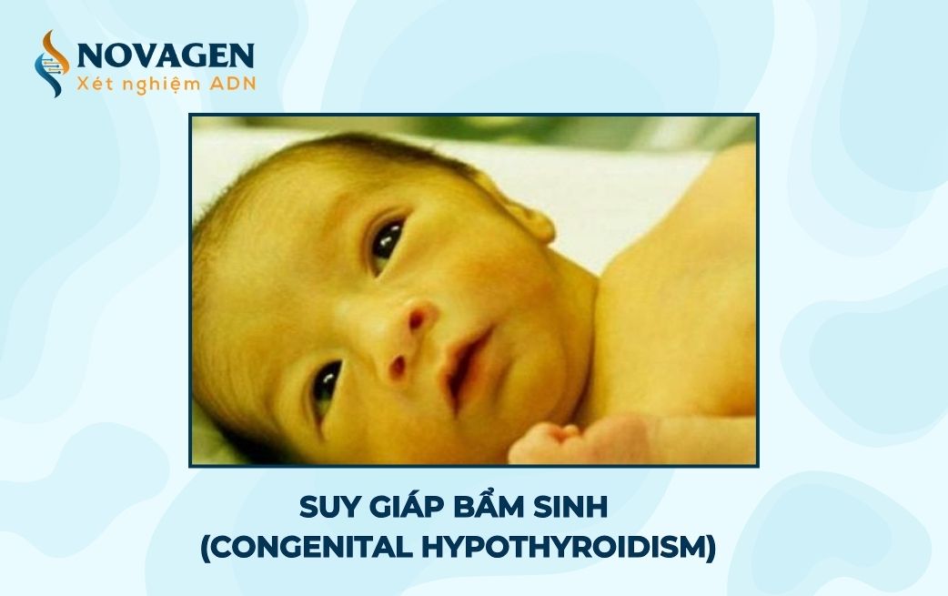 Suy giáp bẩm sinh (Congenital Hypothyroidism - CH) là gì?