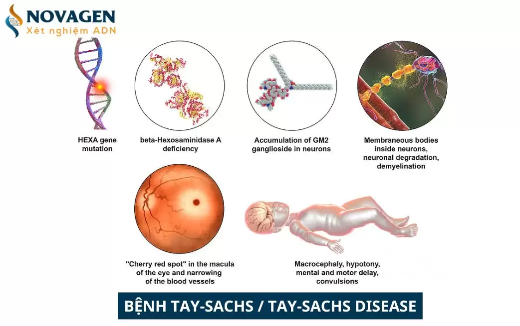 Bệnh Tay-Sachs - Rối loạn di truyền phá hủy hệ thần kinh