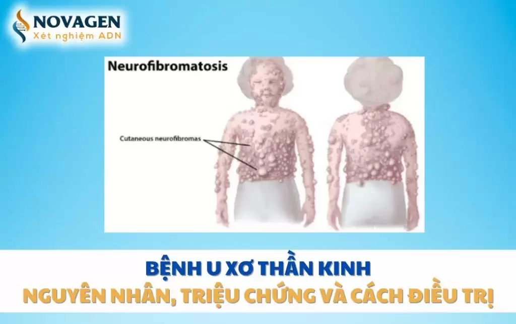 Bệnh u xơ thần kinh: Nguyên nhân, triệu chứng và cách điều trị