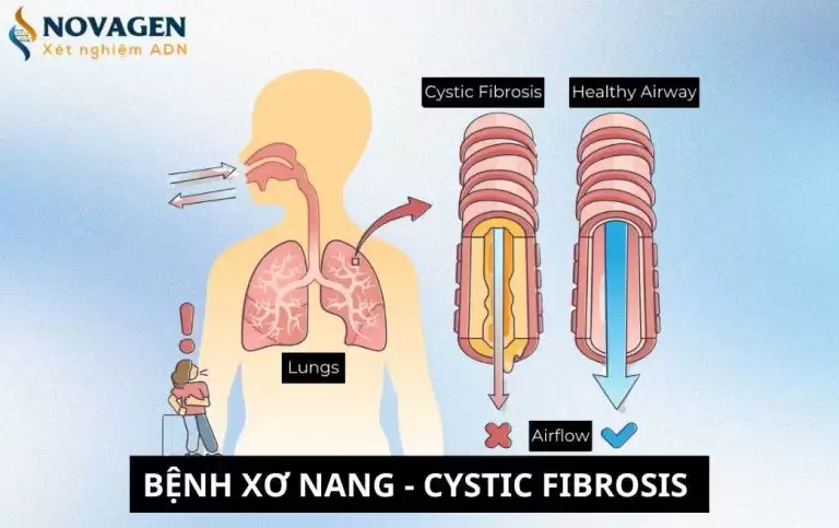 Bệnh Xơ nang là gì? Nguyên nhân, triệu chứng, cách điều trị