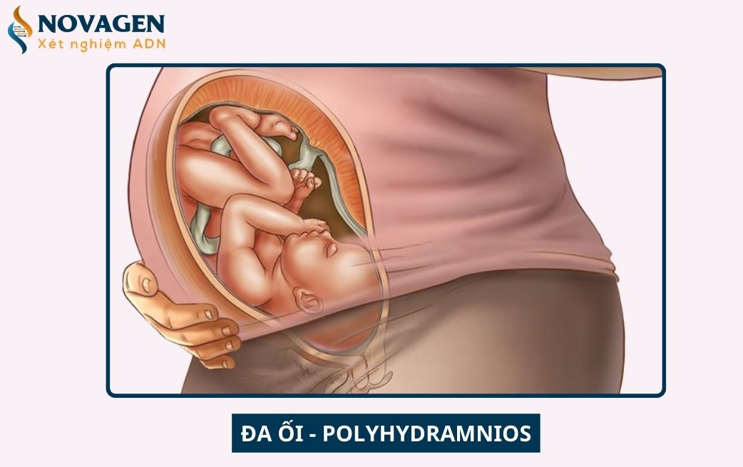 Đa ối là gì? Các biến chứng của tình trạng đa ối