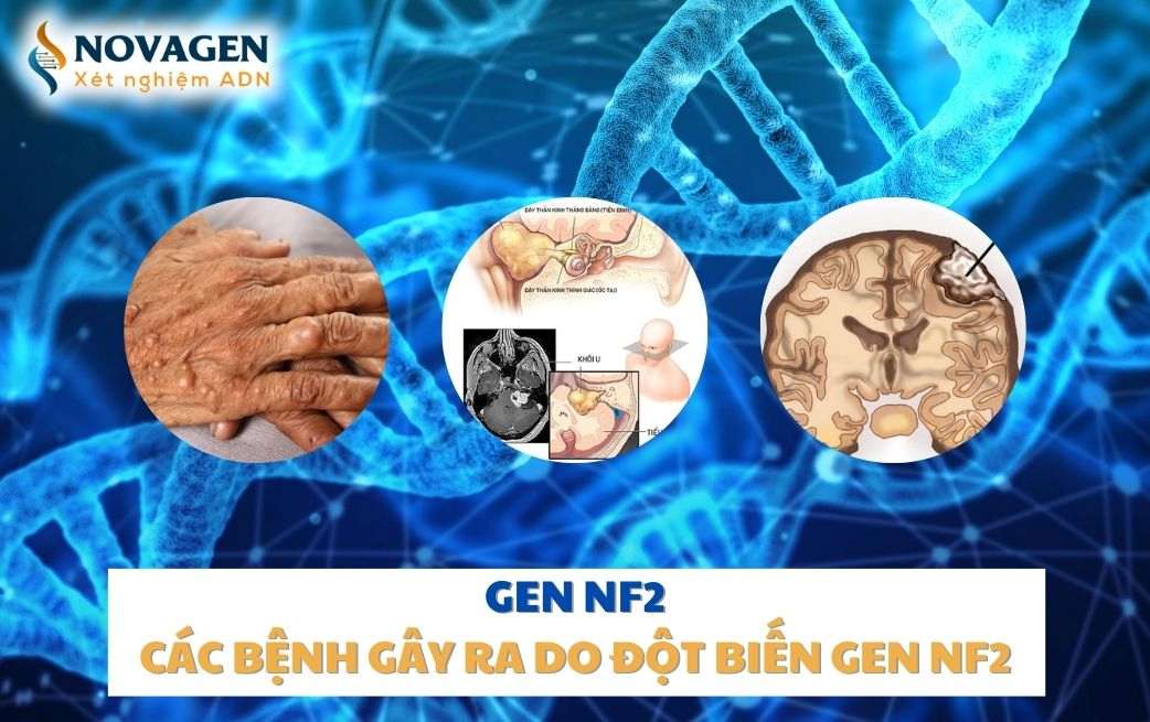 Gen NF2 là gì? Các bệnh gây ra do đột biến gen NF2