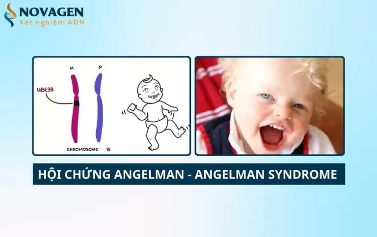 Hội chứng Angelman – Nguyên nhân, triệu chứng và cách điều trị