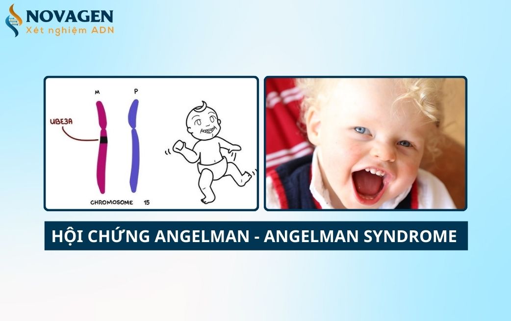 Hội chứng Angelman - Nguyên nhân, triệu chứng và cách điều trị