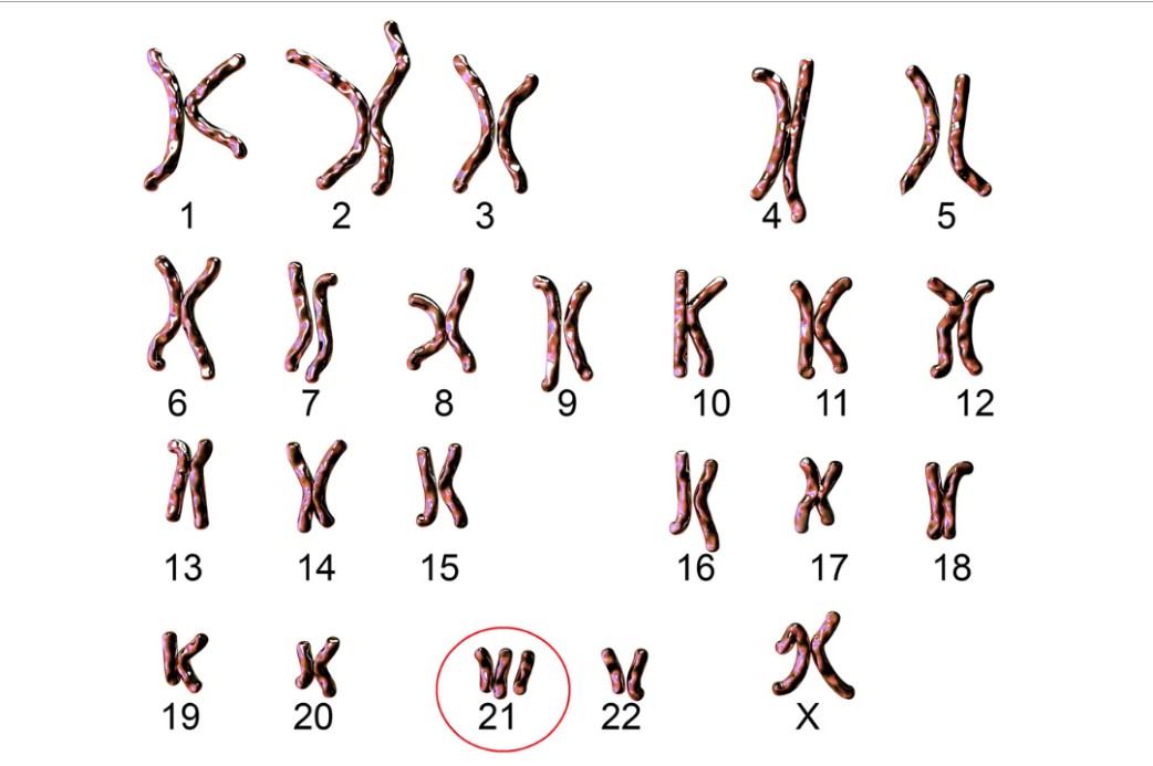 Tam nhiễm sắc thể 21 (hội chứng Down)